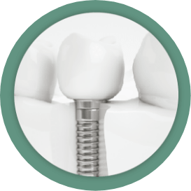 Dental Implants