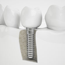 Dental implants