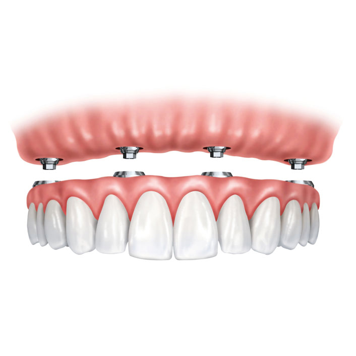 Implant Suprorted Dentures 
