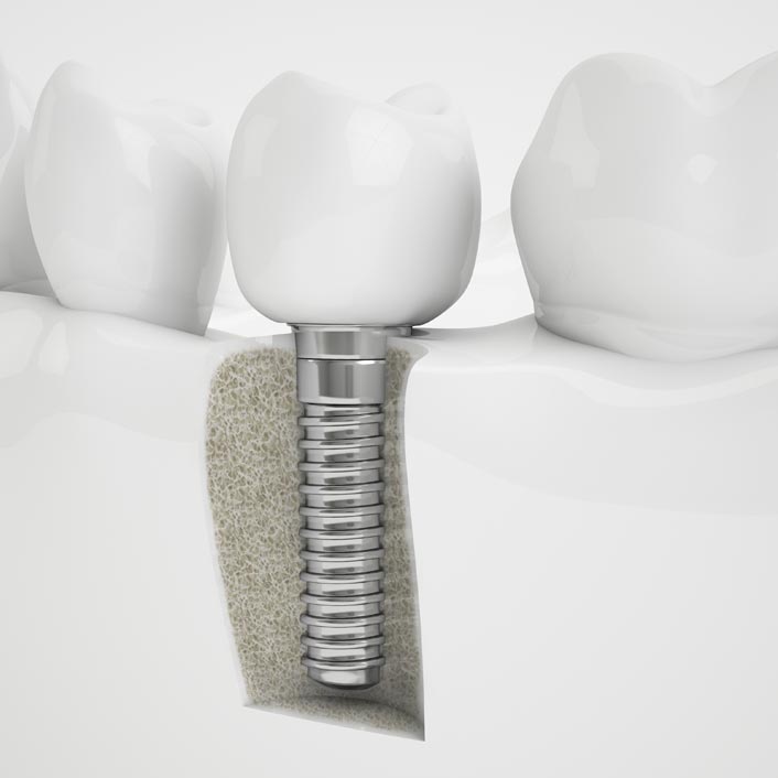 Implant Restoration